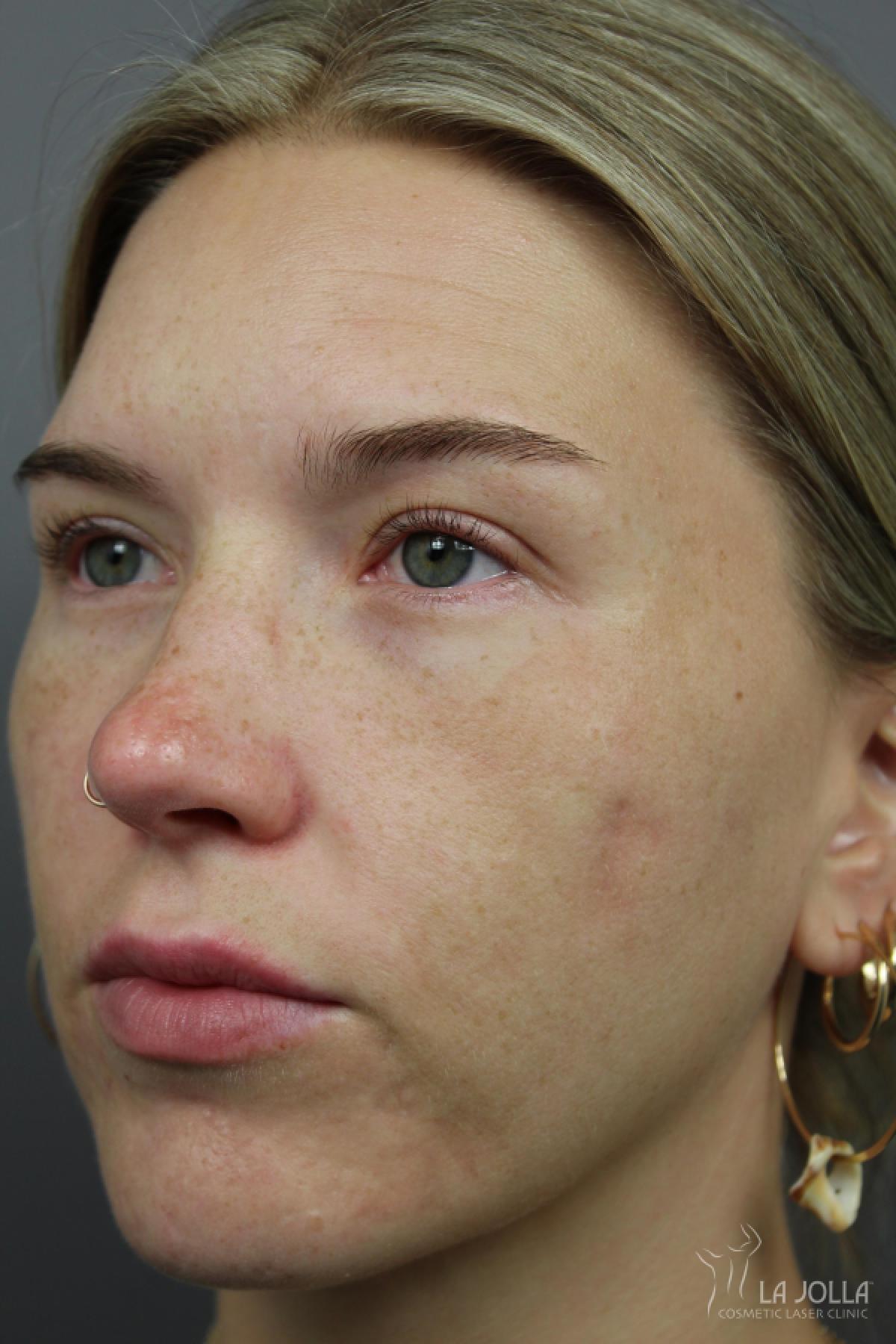 Acne Scars: Patient 2 - After 3