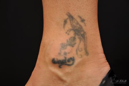 Tattoo Removal: Patient 2 - Before 