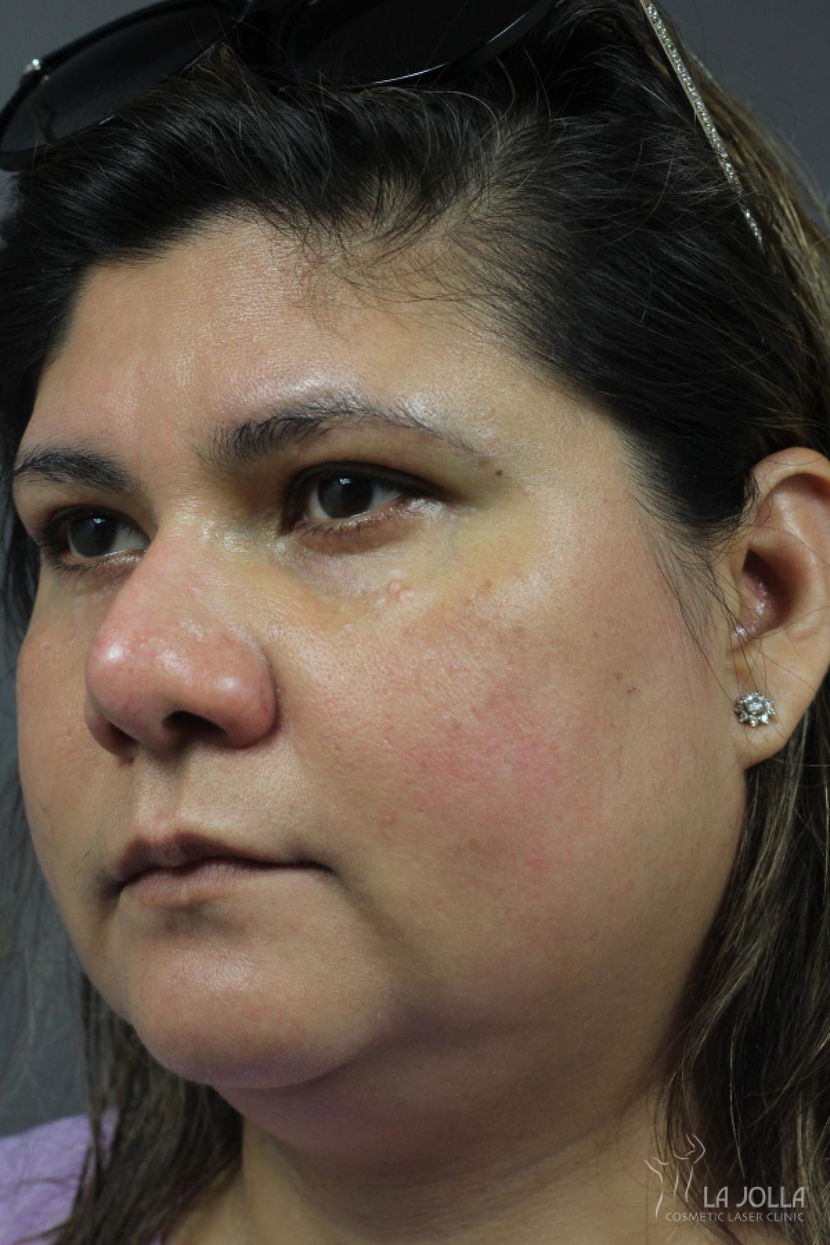 Chemical Peel: Patient 5 - Before 1