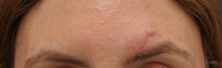 Fraxel®: Patient 10 - Before 