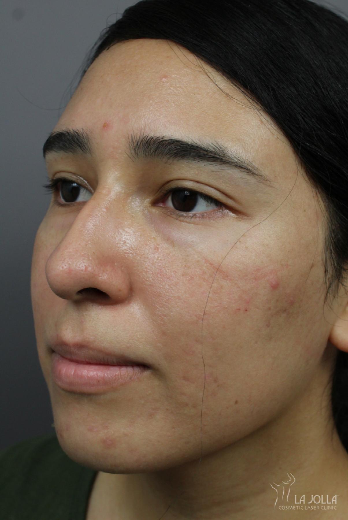 Acne Rejuvenation: Patient 5 - After 2