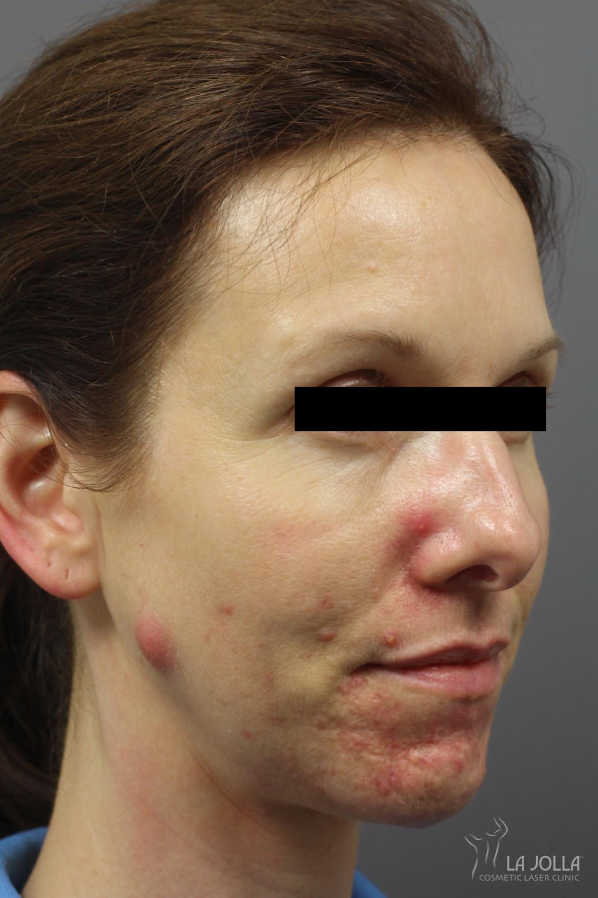 Acne Rejuvenation: Patient 3 - Before 2