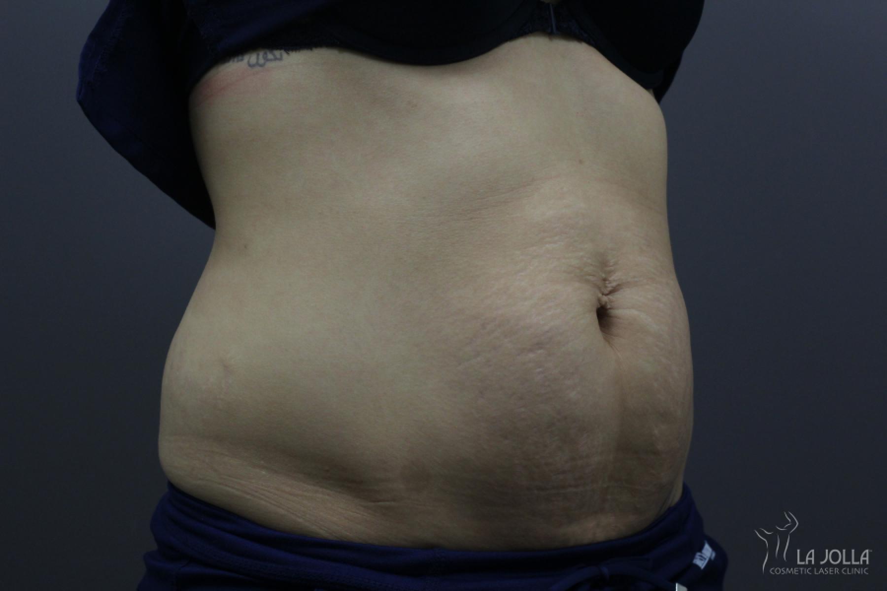 StarWalker® Laser: Patient 8 - After  