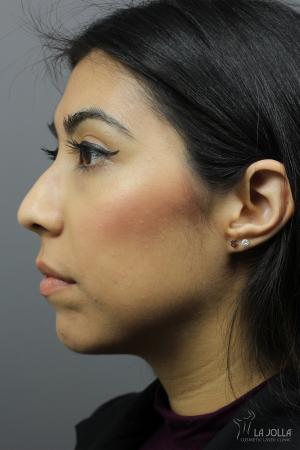 Non-Surgical Nose Job: Patient 4 - Before 