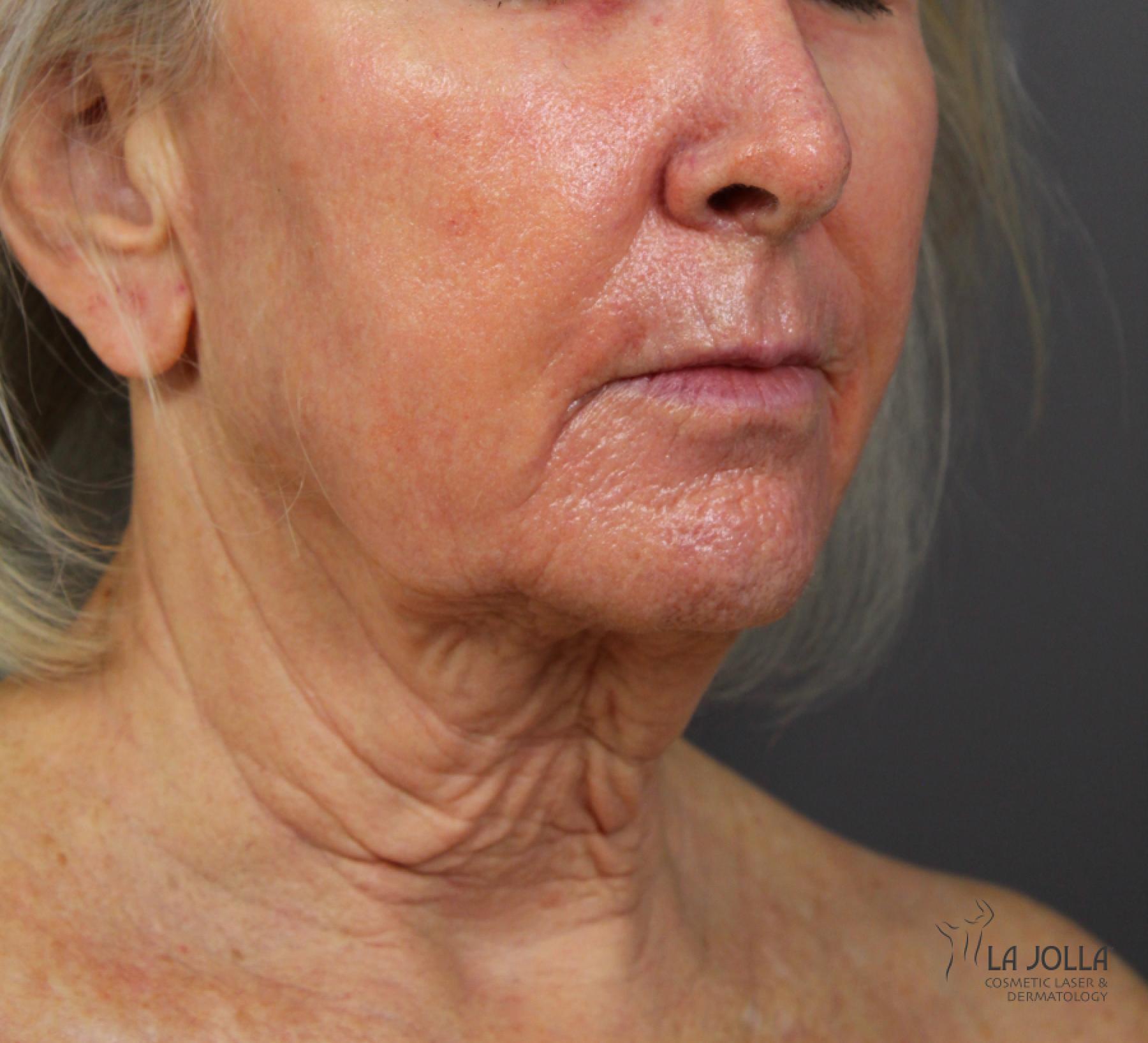 CO2 Laser: Patient 4 - After 3