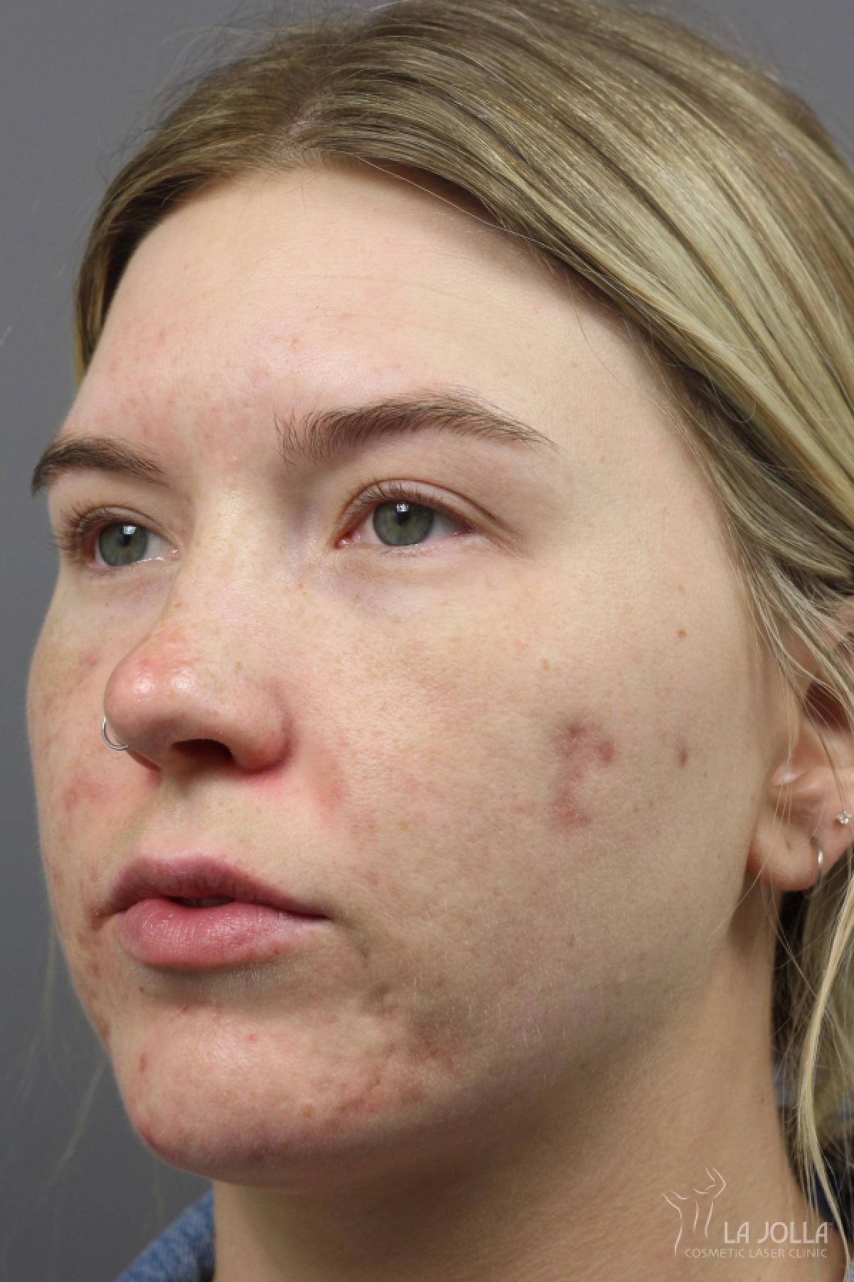 StarWalker® Laser: Patient 11 - Before 1