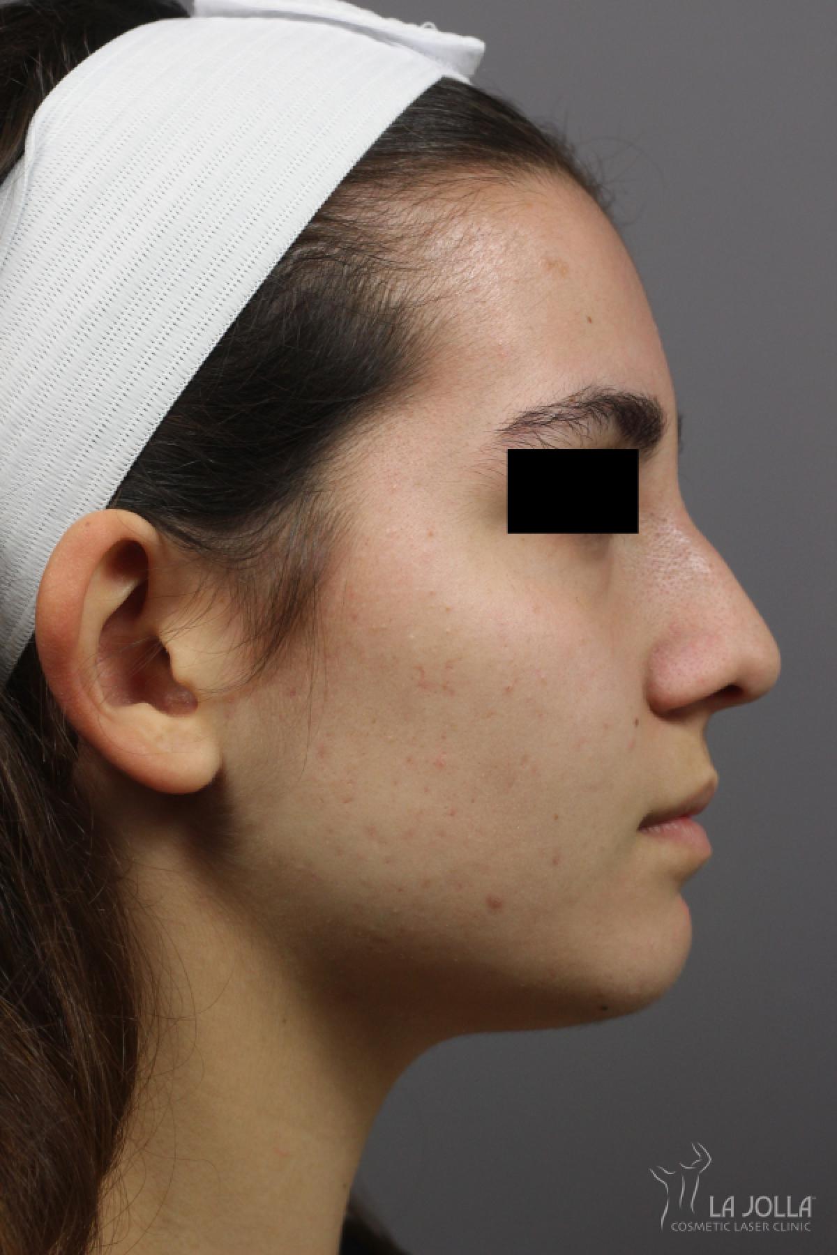 Non-Surgical Nose Job: Patient 2 - After  