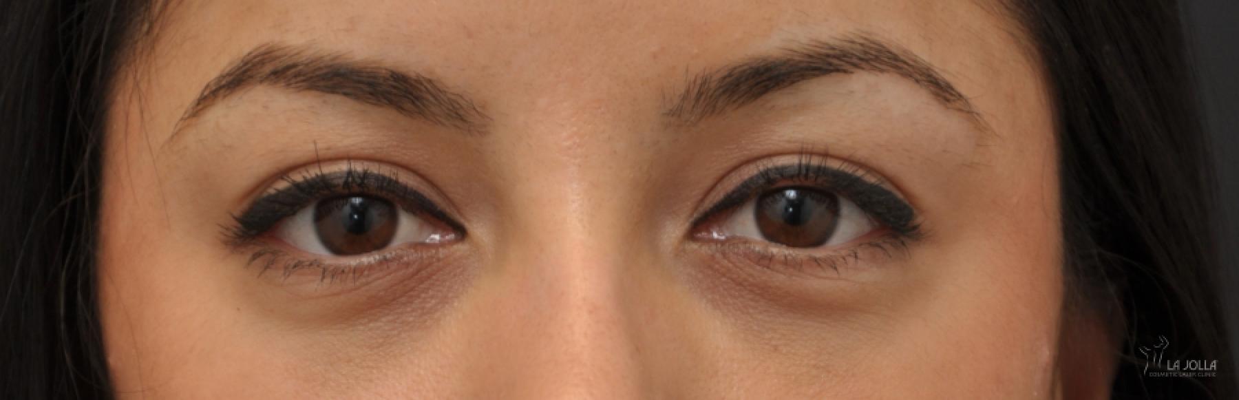 Under Eye Filler: Patient 4 - After  