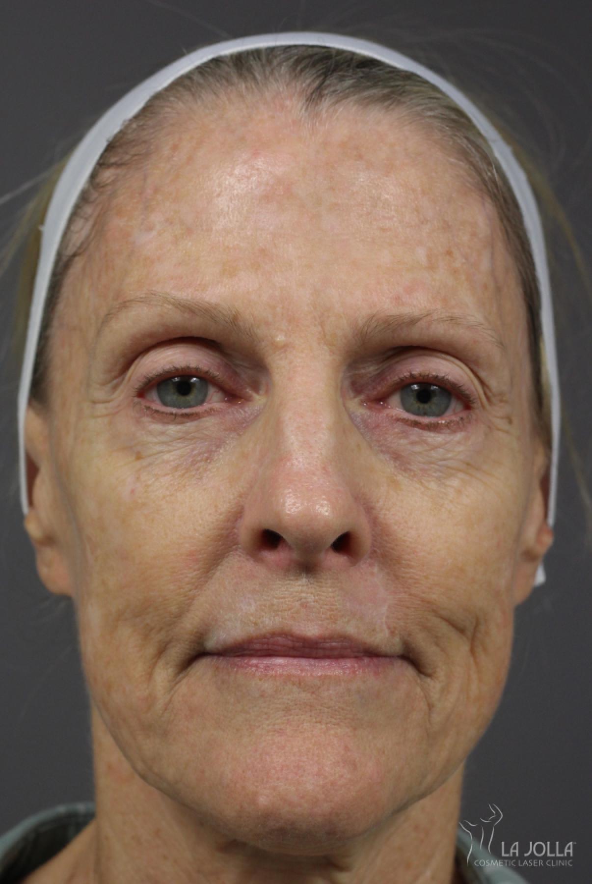 CO2 Laser: Patient 14 - Before 1