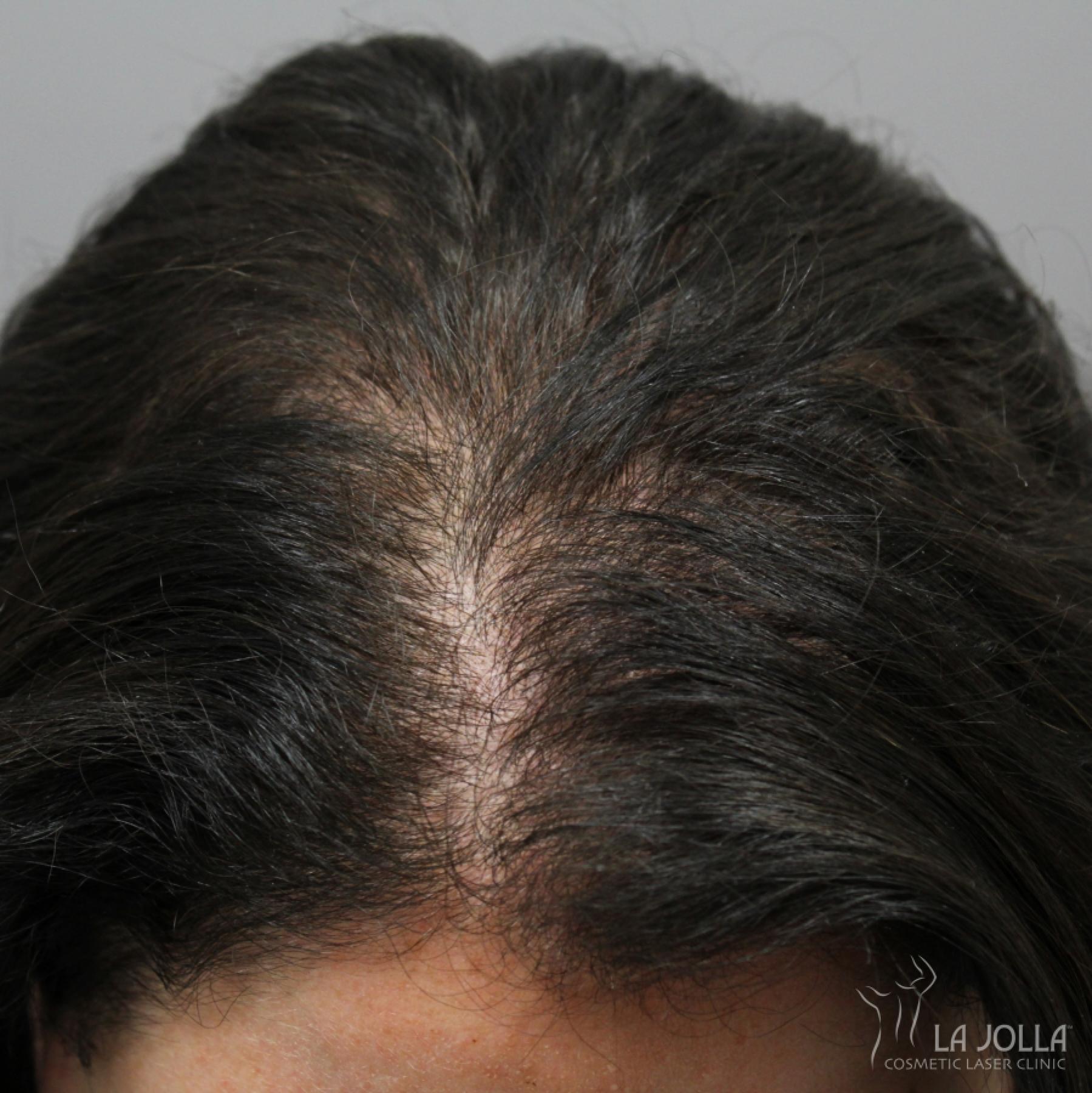 Hair Restoration: Patient 4 - After 1