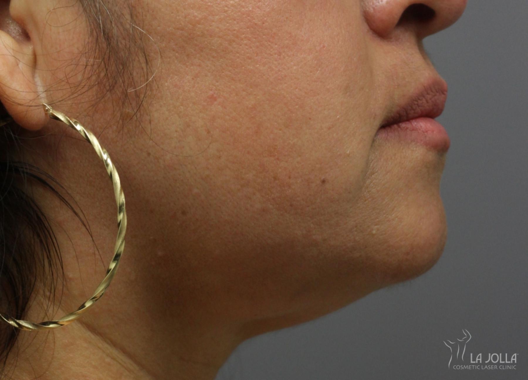 Kybella: Patient 5 - After  