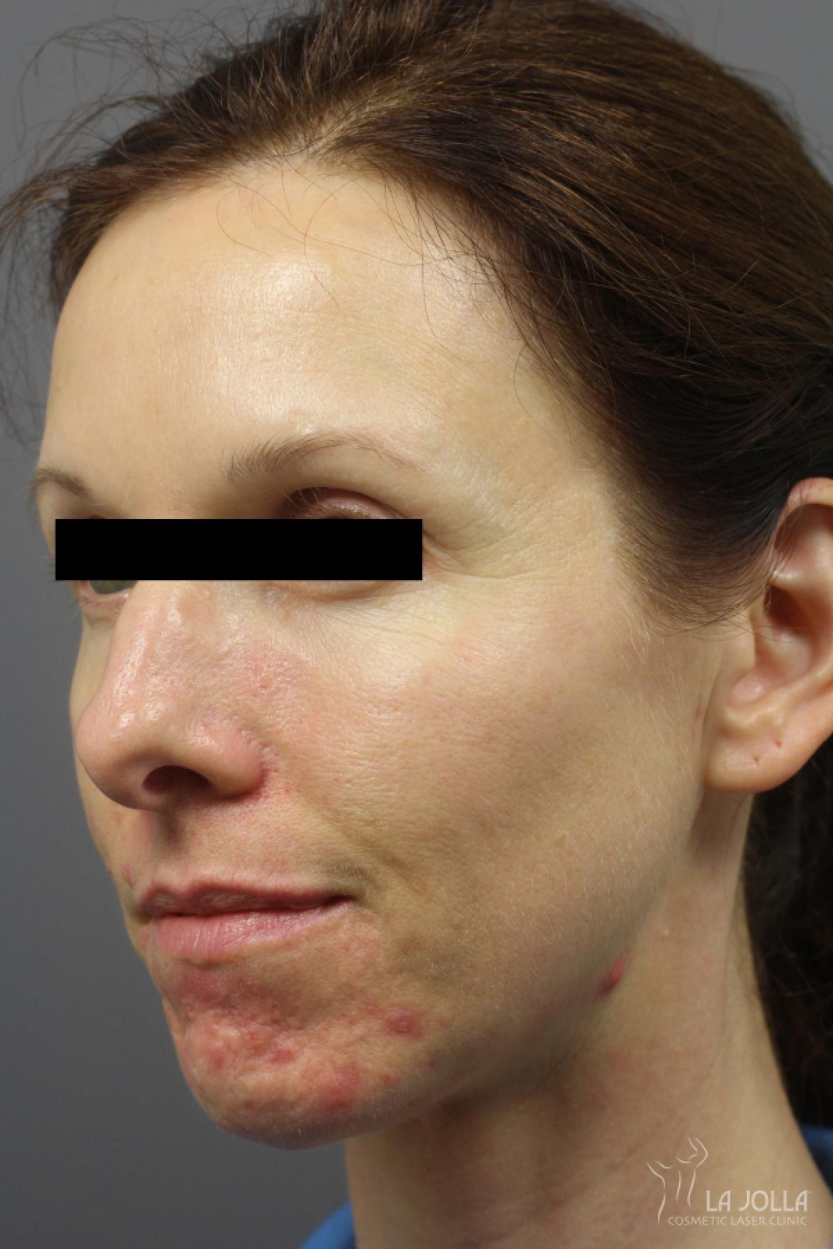 Acne Rejuvenation: Patient 3 - Before and After 3