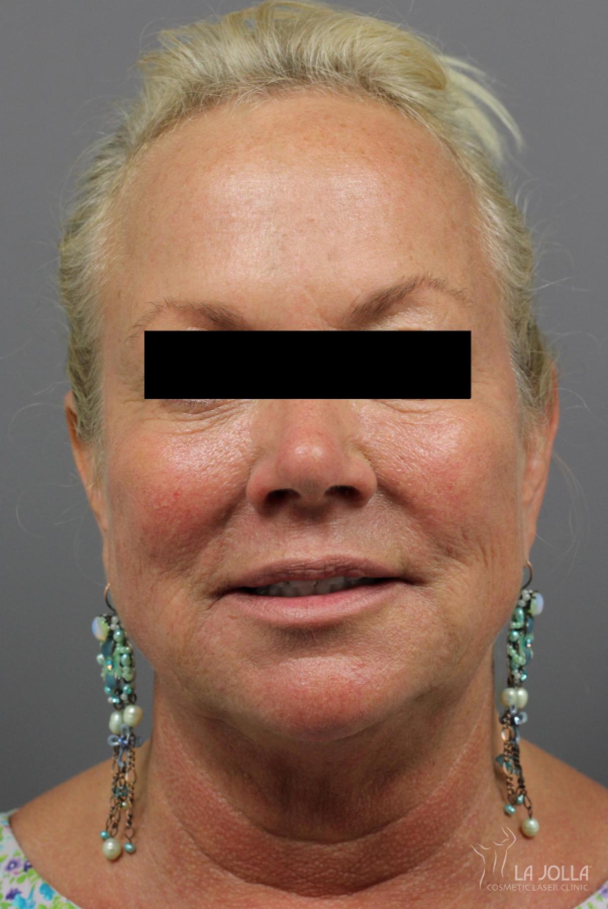 CoolSculpting®: Patient 10 - After  