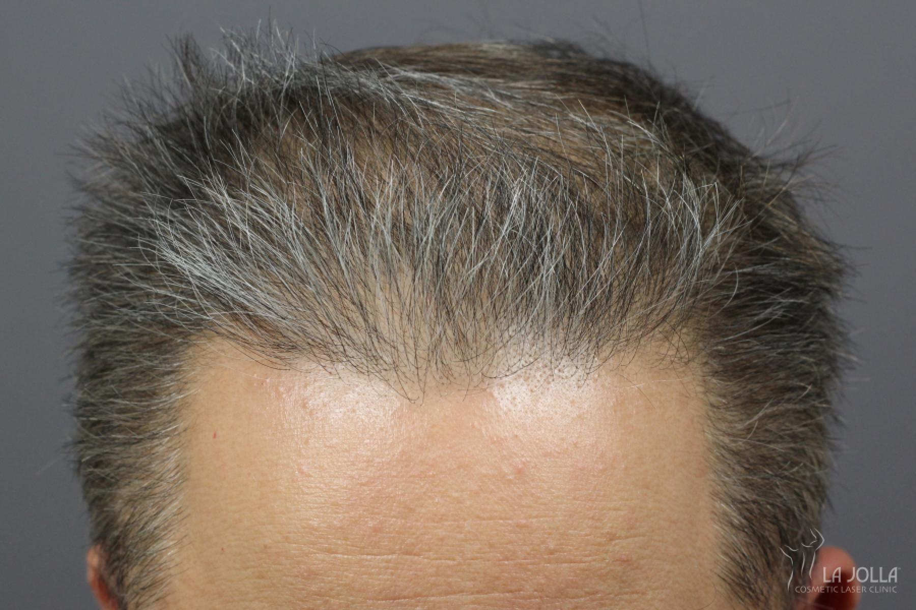 Hair Restoration: Patient 3 - After 1