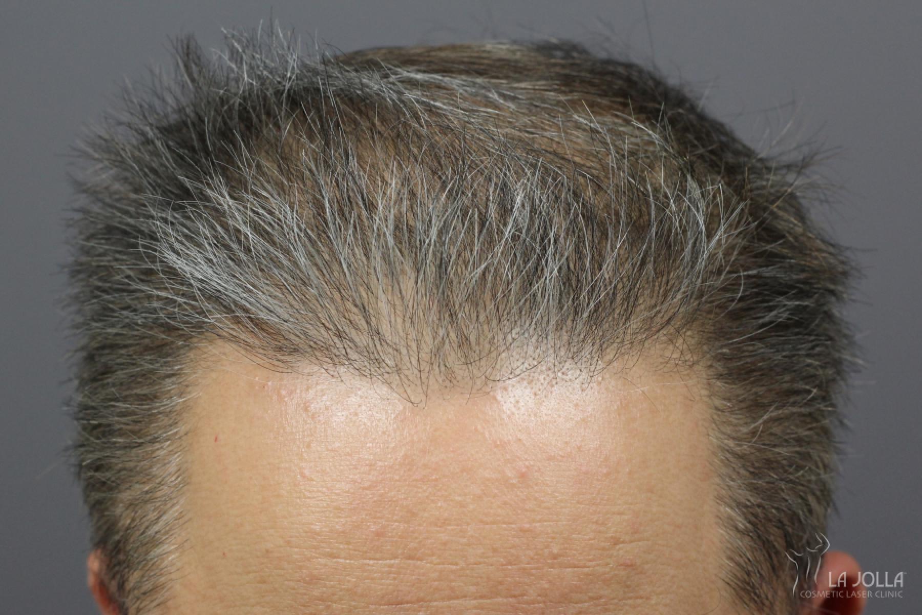 Hair Restoration: Patient 2 - After  