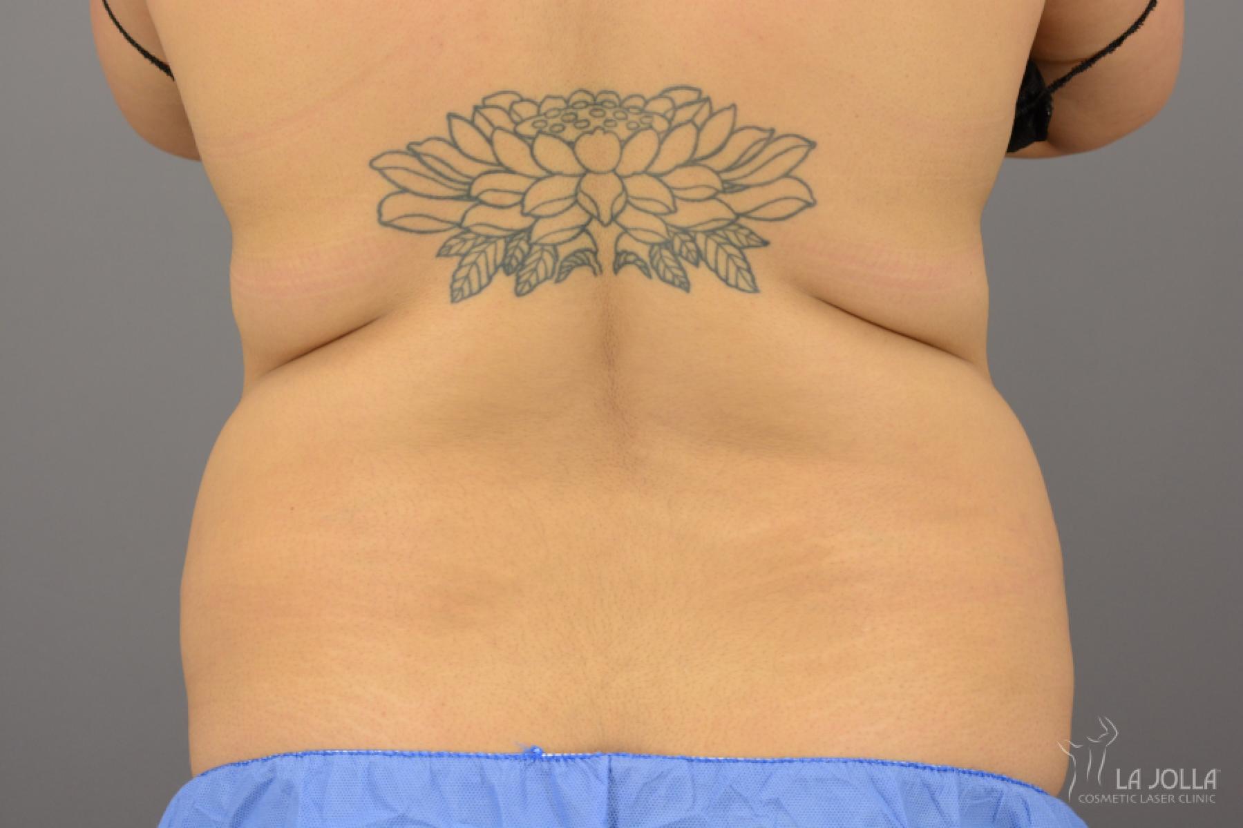 CoolSculpting®: Patient 15 - Before 1