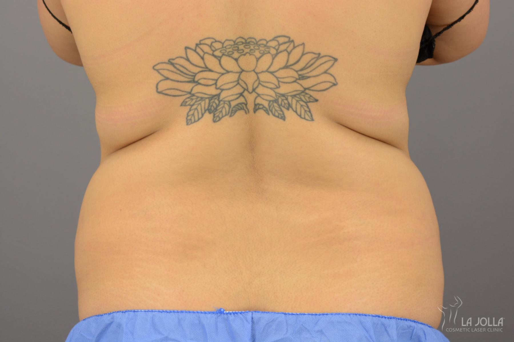 CoolSculpting®: Patient 14 - Before 1