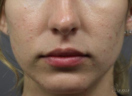 Juvéderm® XC: Patient 9 - After  