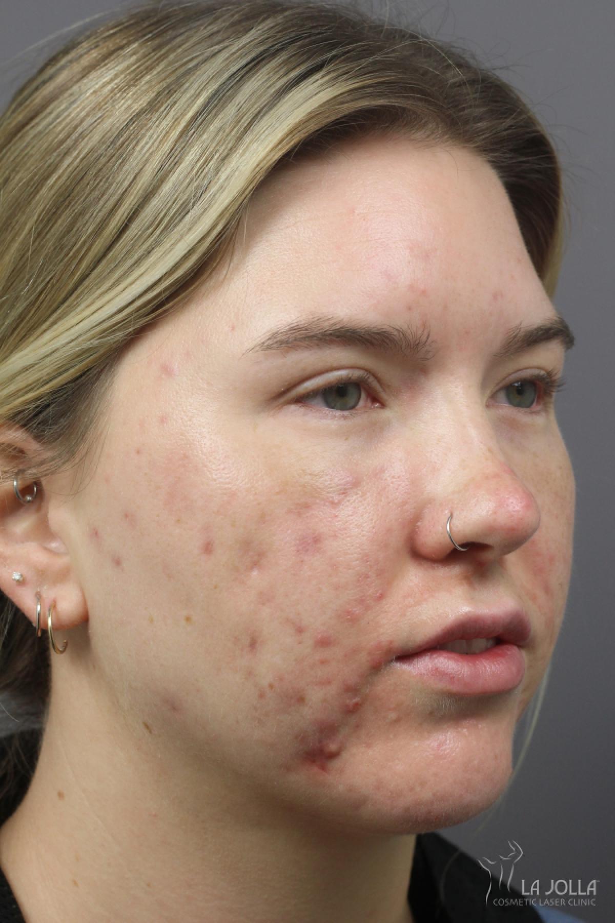 Acne Scarring Patient 1 Before Procedure