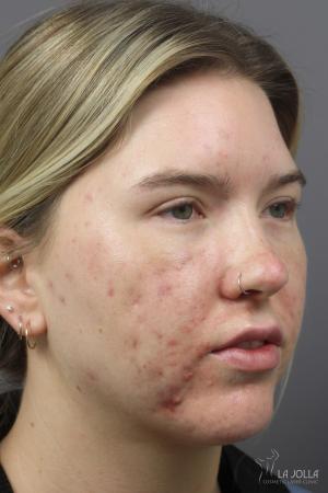 Acne Scars: Patient 2 - Before 