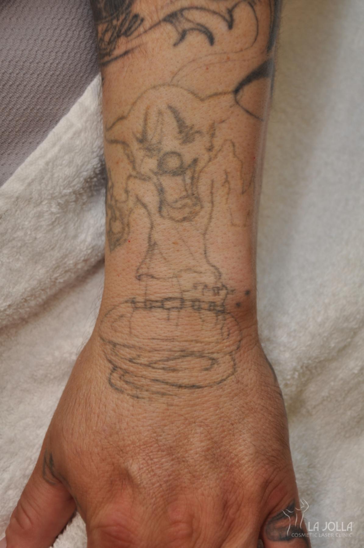 Laser Tattoo Removal Patient 1 Before Procedure