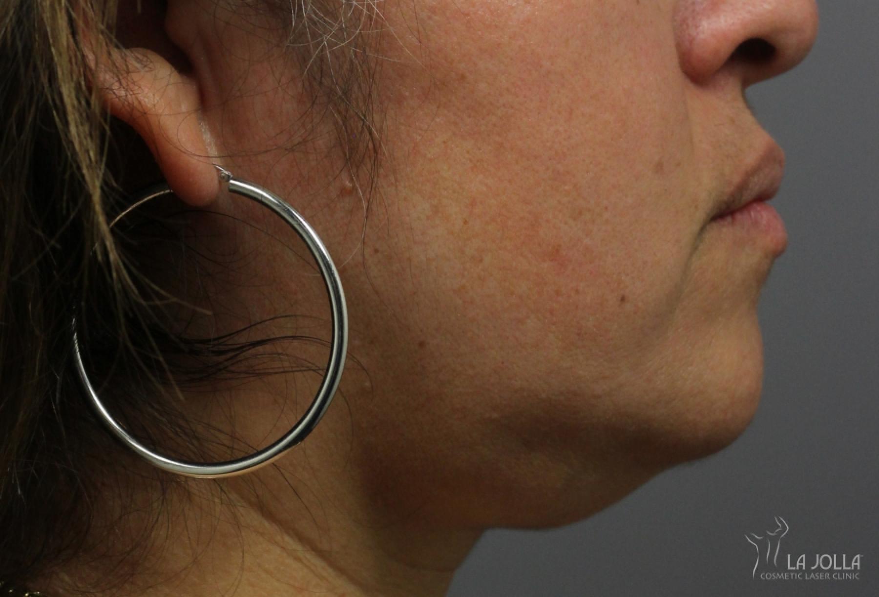 Kybella: Patient 5 - Before 