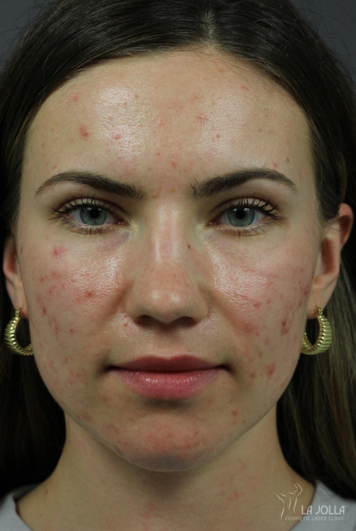 Acne Rejuvenation: Patient 7 - Before 1