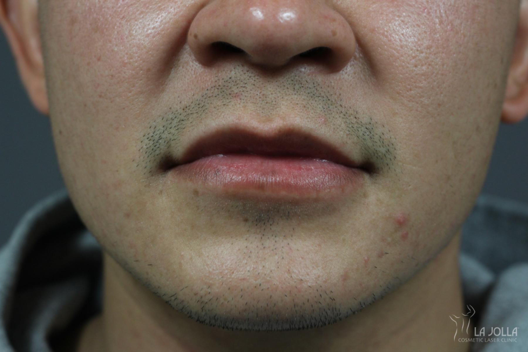 Lip Filler: Patient 10 - After 1