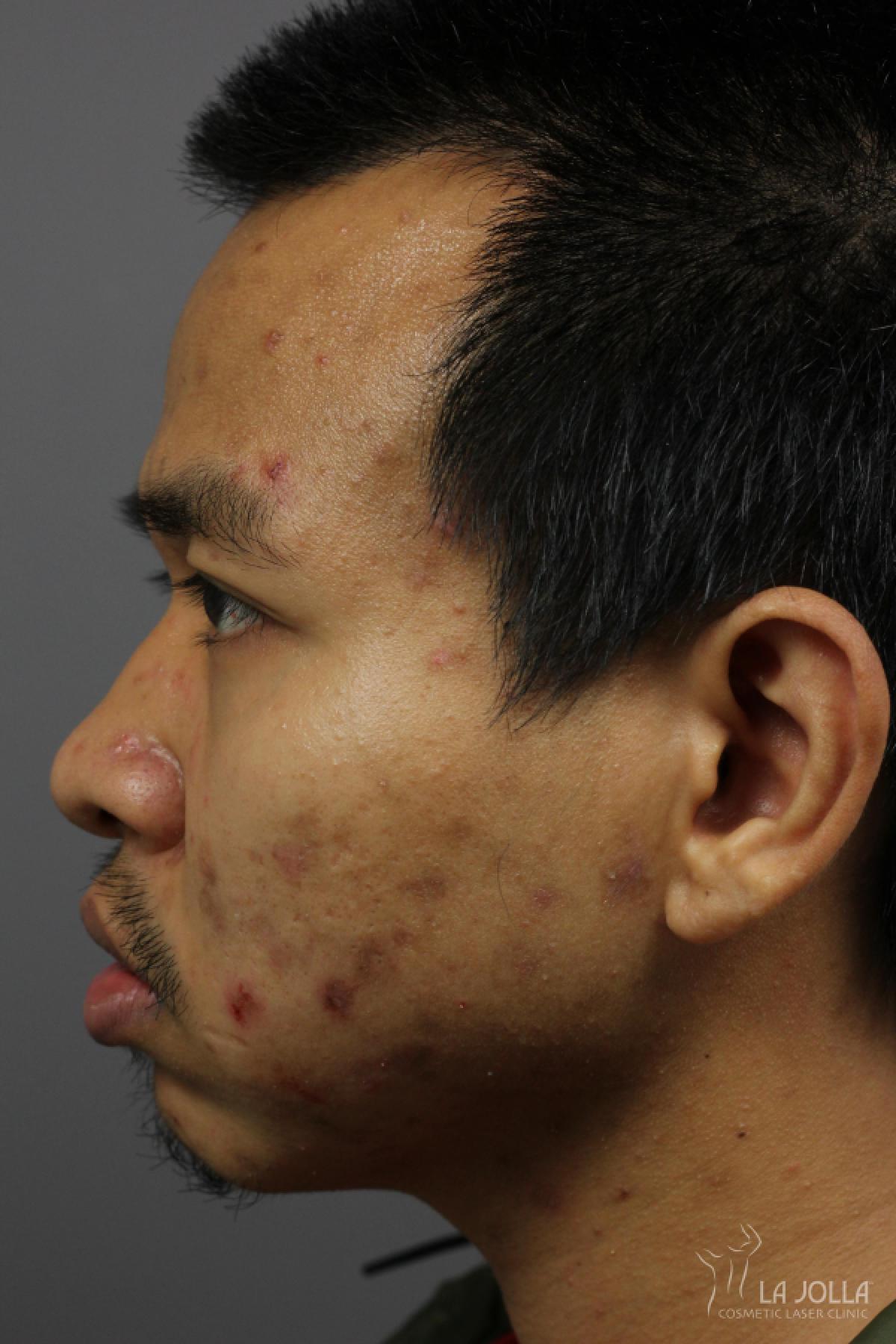 Acne Rejuvenation: Patient 2 - Before and After 5
