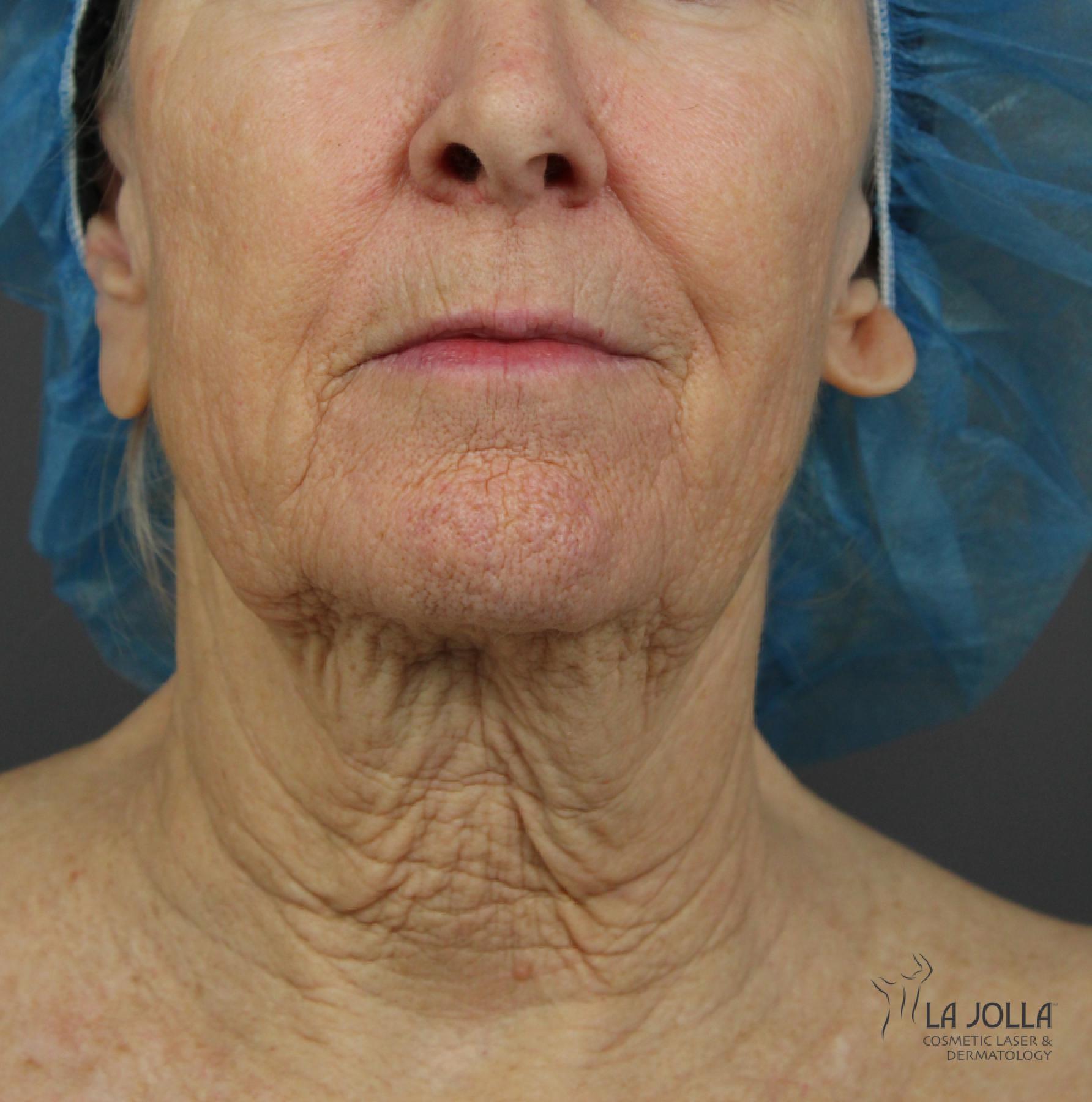 CO2 Laser: Patient 4 - Before 