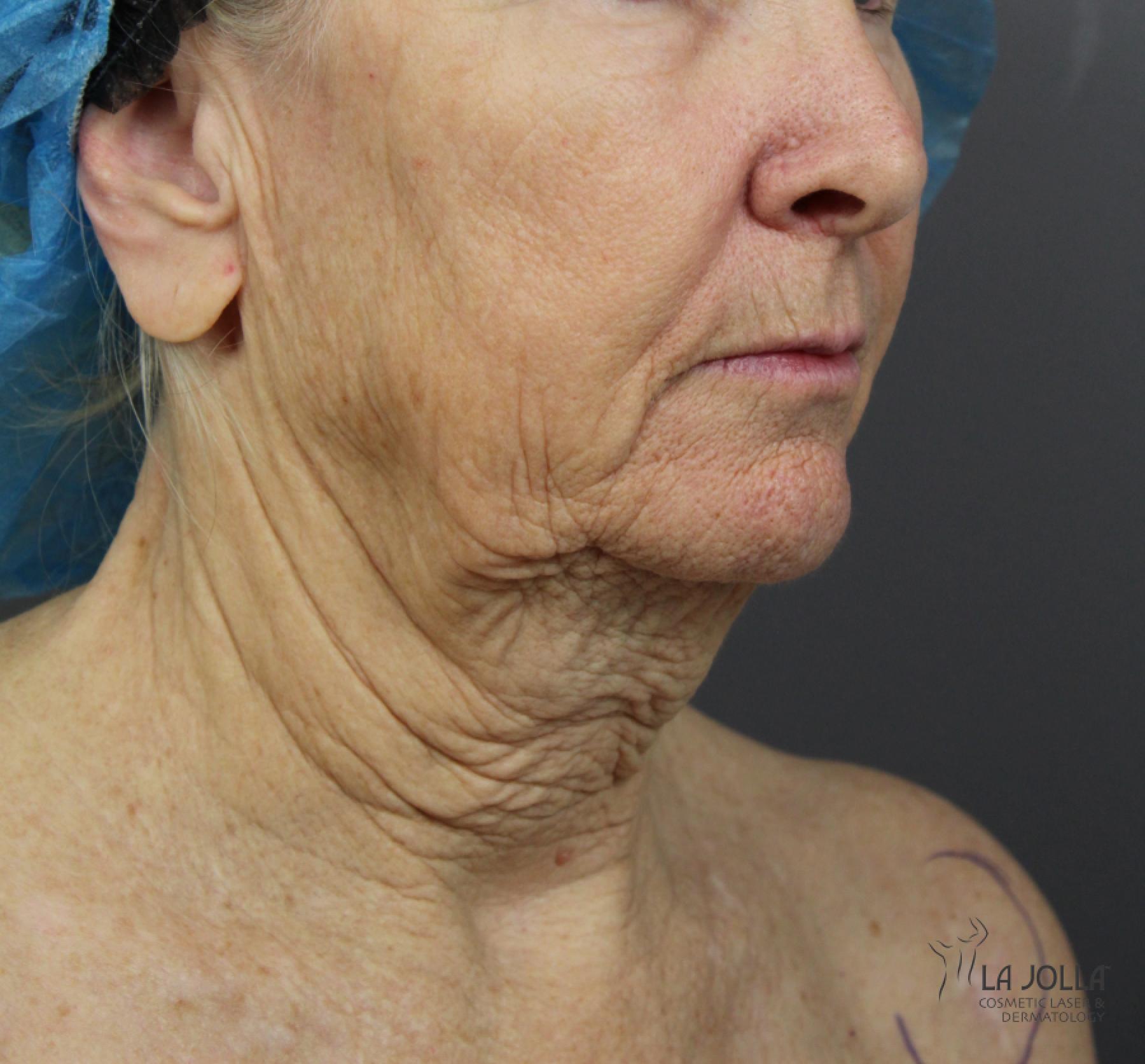 CO2 Laser: Patient 4 - Before and After 3