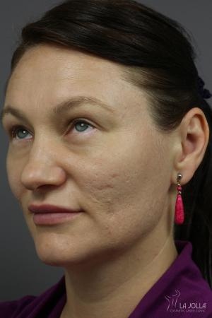 Acne Scars: Patient 5 - Before 