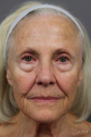 SP Dynamis: Patient 9 - Before 