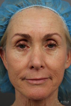 CO2 Laser: Patient 4 - Before 