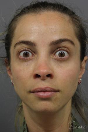 BOTOX® Cosmetic: Patient 1 - After  