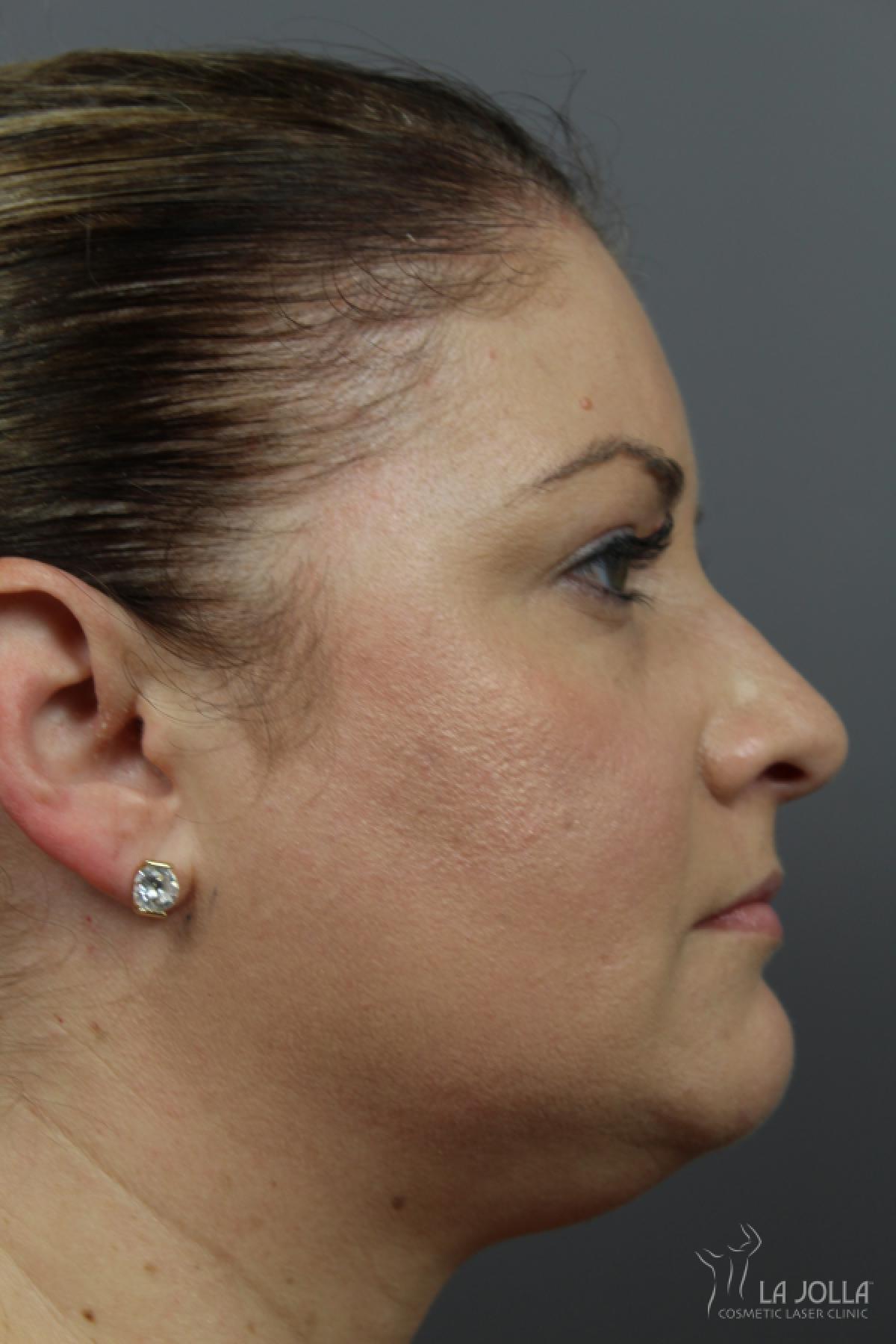 Kybella: Patient 1 - Before 