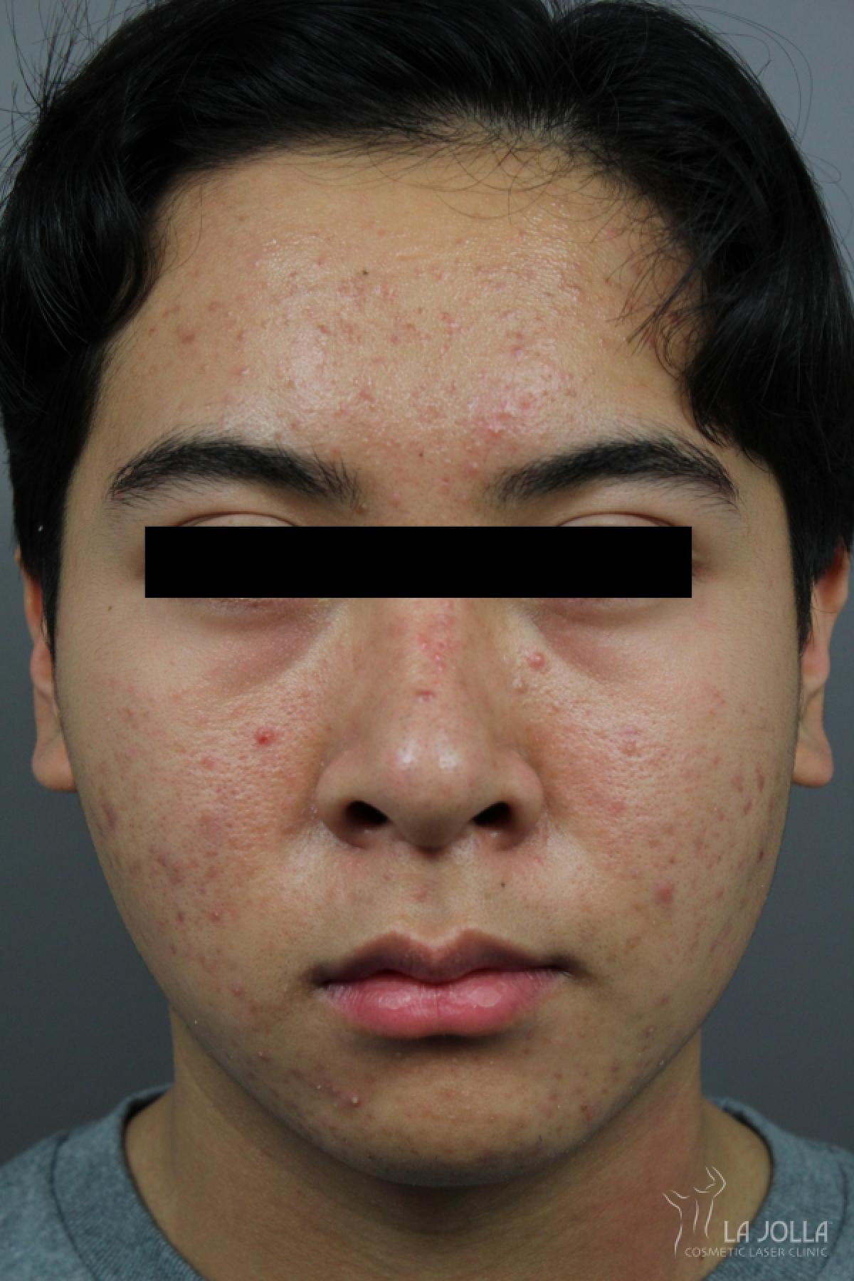 Chemical Peel: Patient 1 - Before 