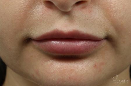 Lip Filler: Patient 1 - After  