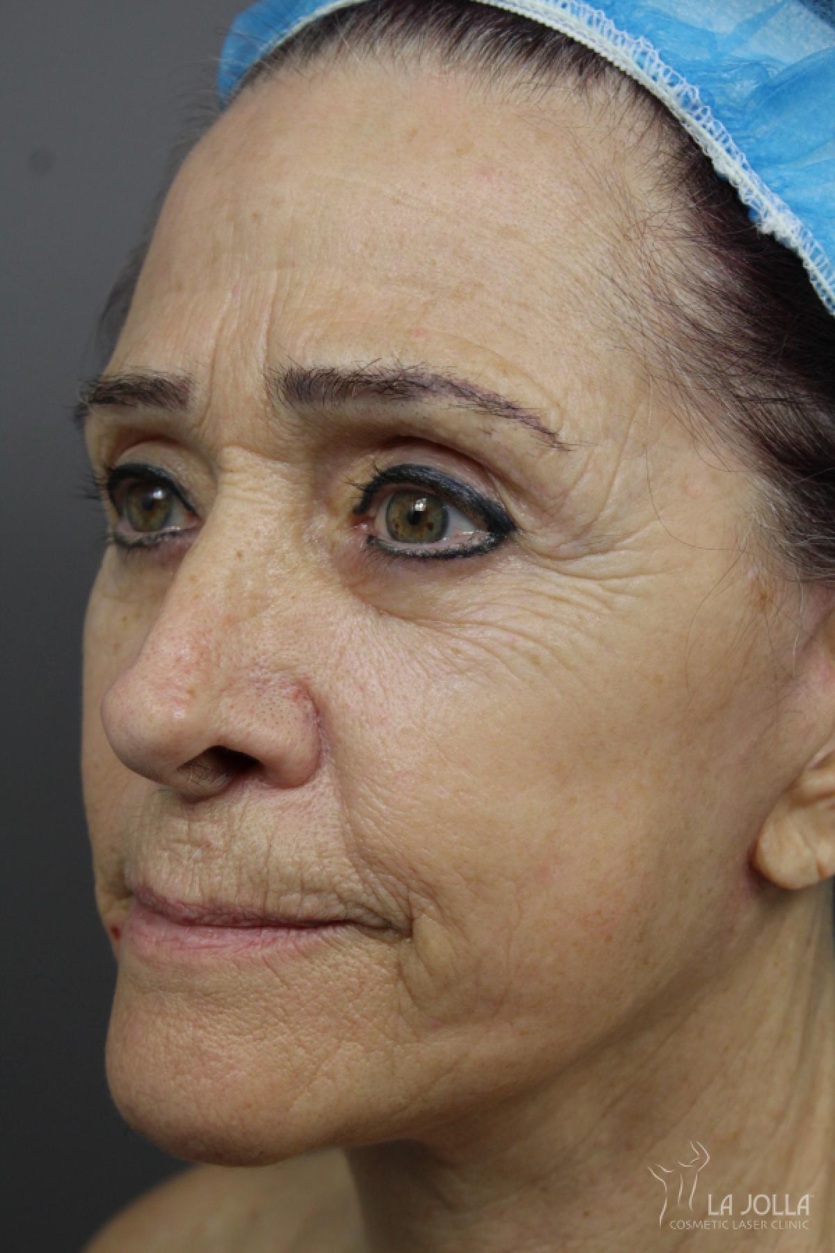 Sculptra®: Patient 7 - Before and After 2