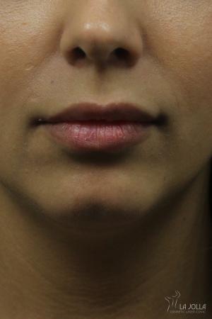 Restylane® Kysse: Patient 2 - After  