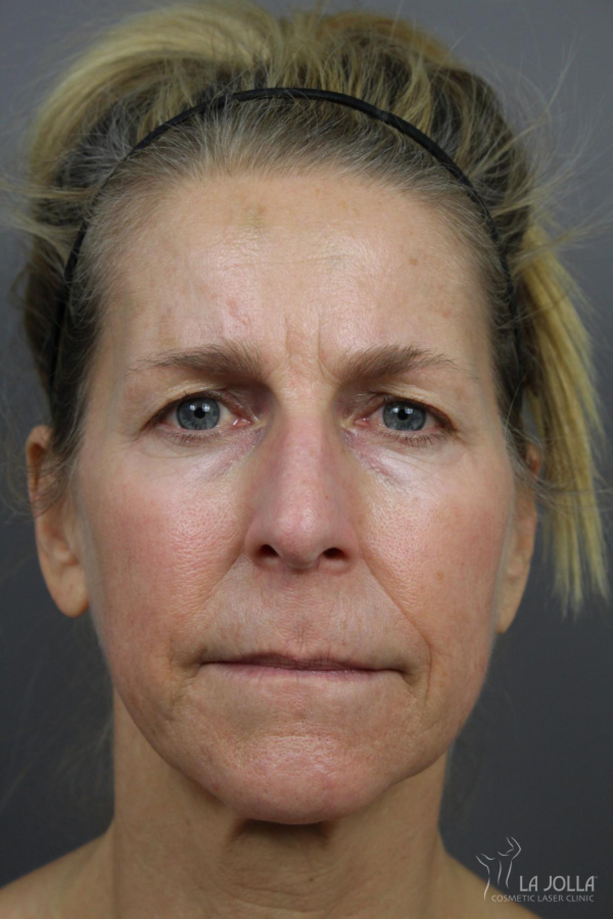 6D Platinum Laser Lift: Patient 3 - Before 