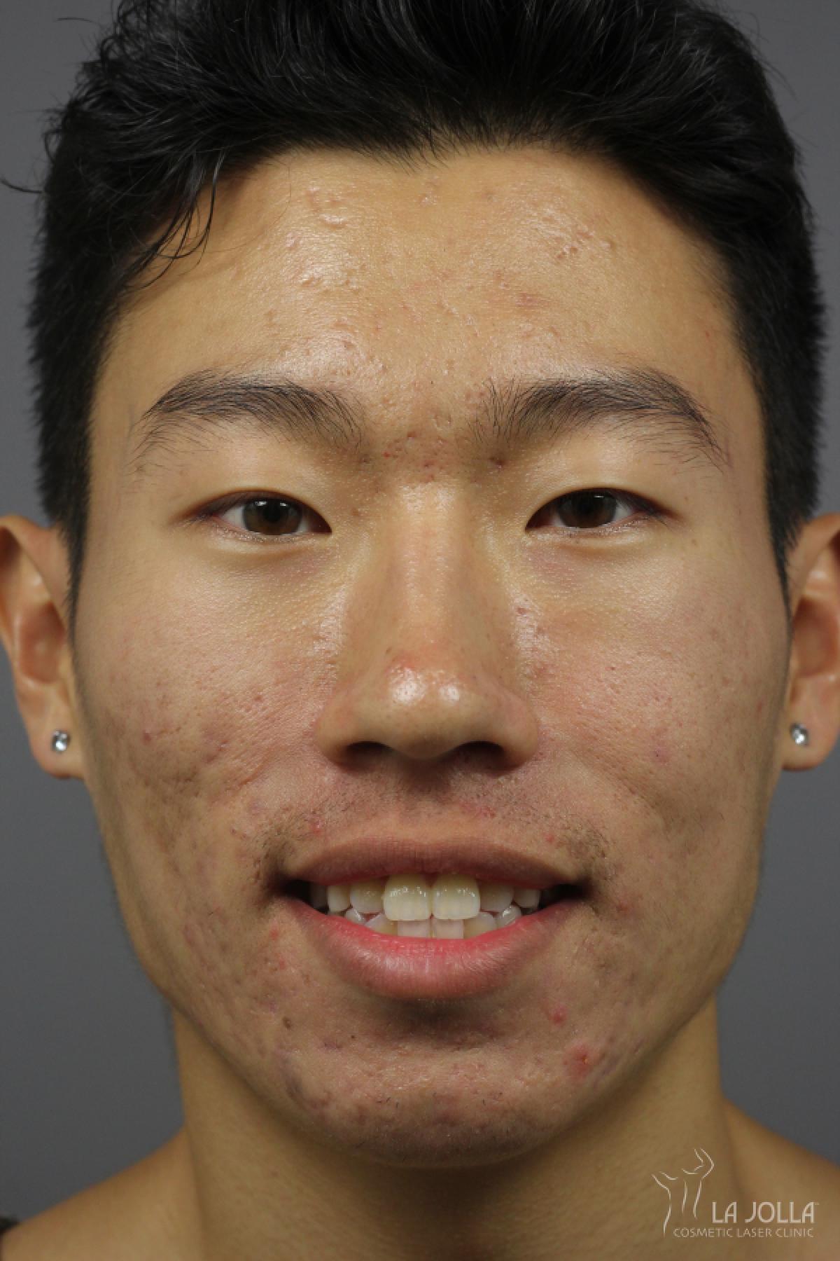 StarWalker® Laser: Patient 5 - Before 