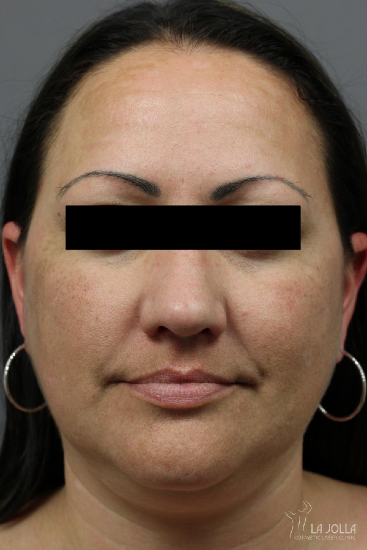 Kybella: Patient 2 - Before and After 2