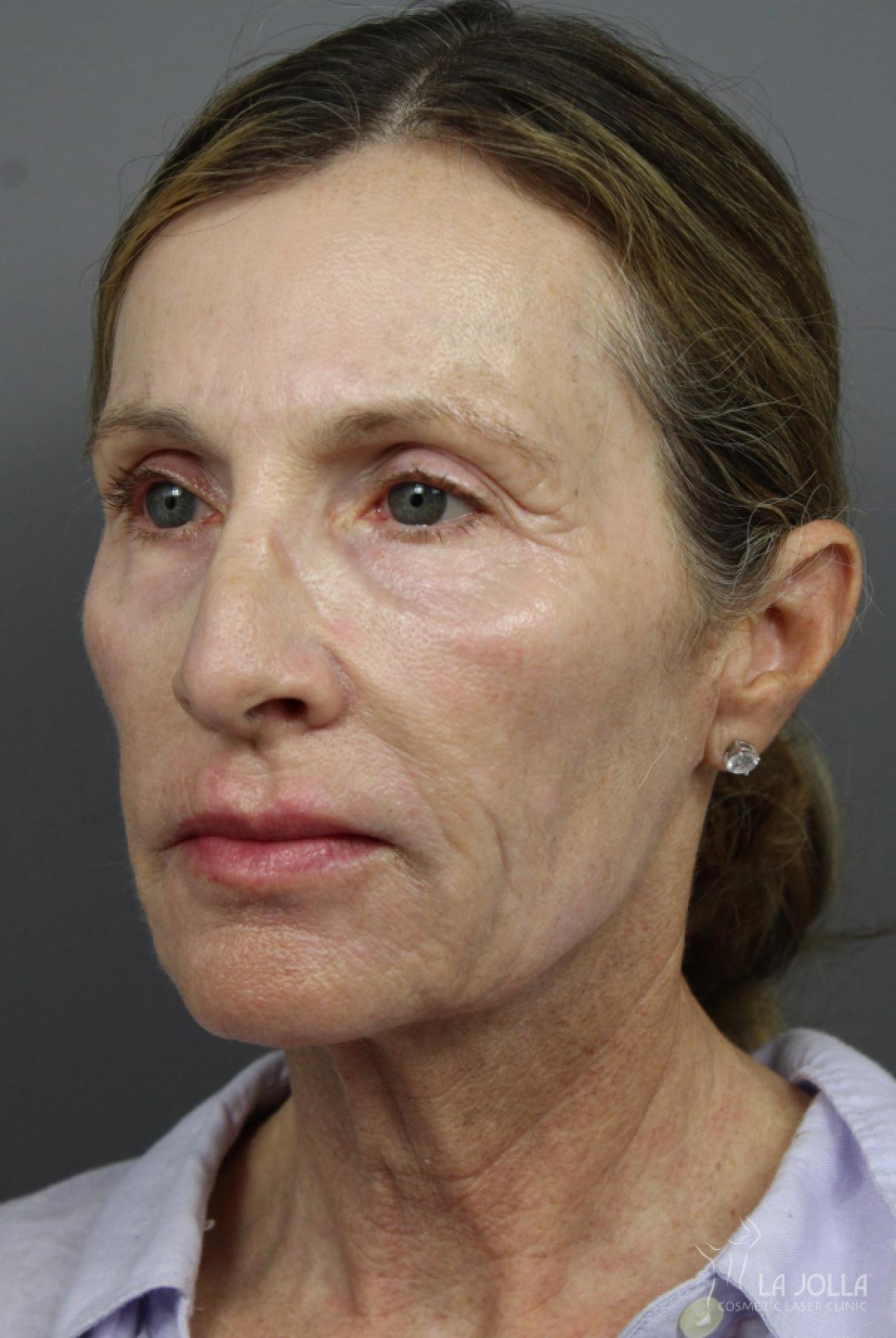 6D Platinum Laser Lift: Patient 2 - After  