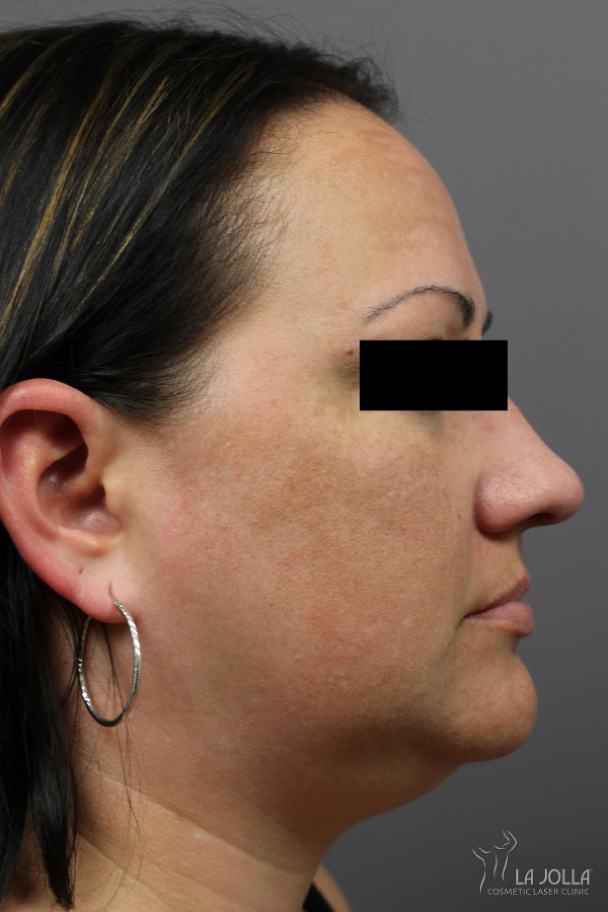 Kybella Patient 1 Before Procedure