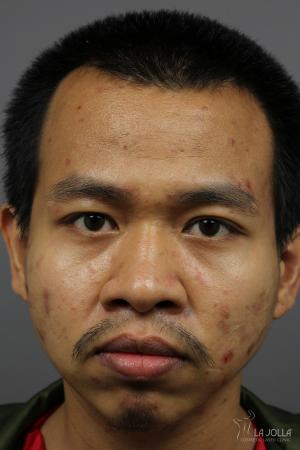 Acne Rejuvenation: Patient 2 - Before 