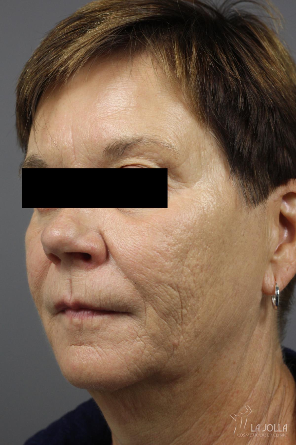 Dermal Fillers Patient 1 After Procedure