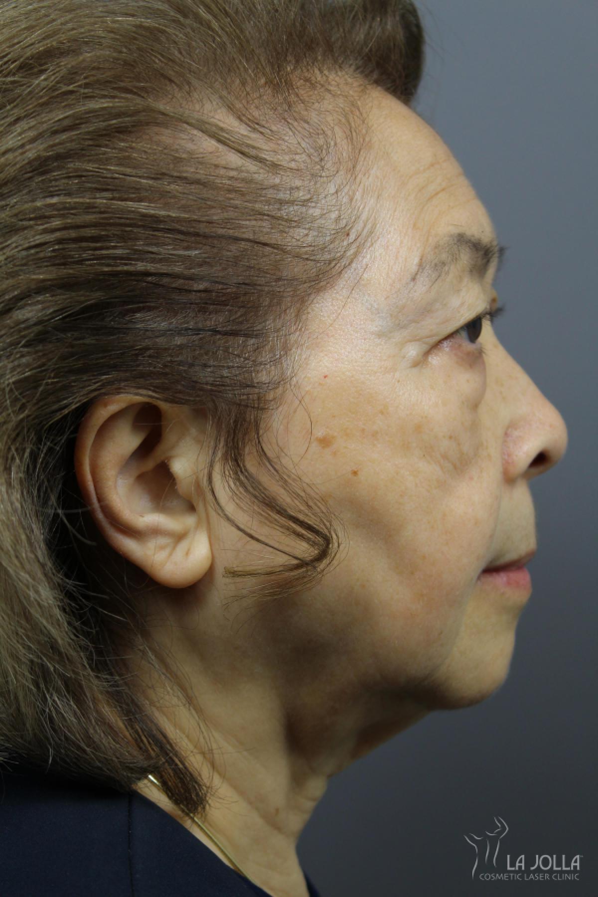 Ultherapy Patient 1 After Procedure