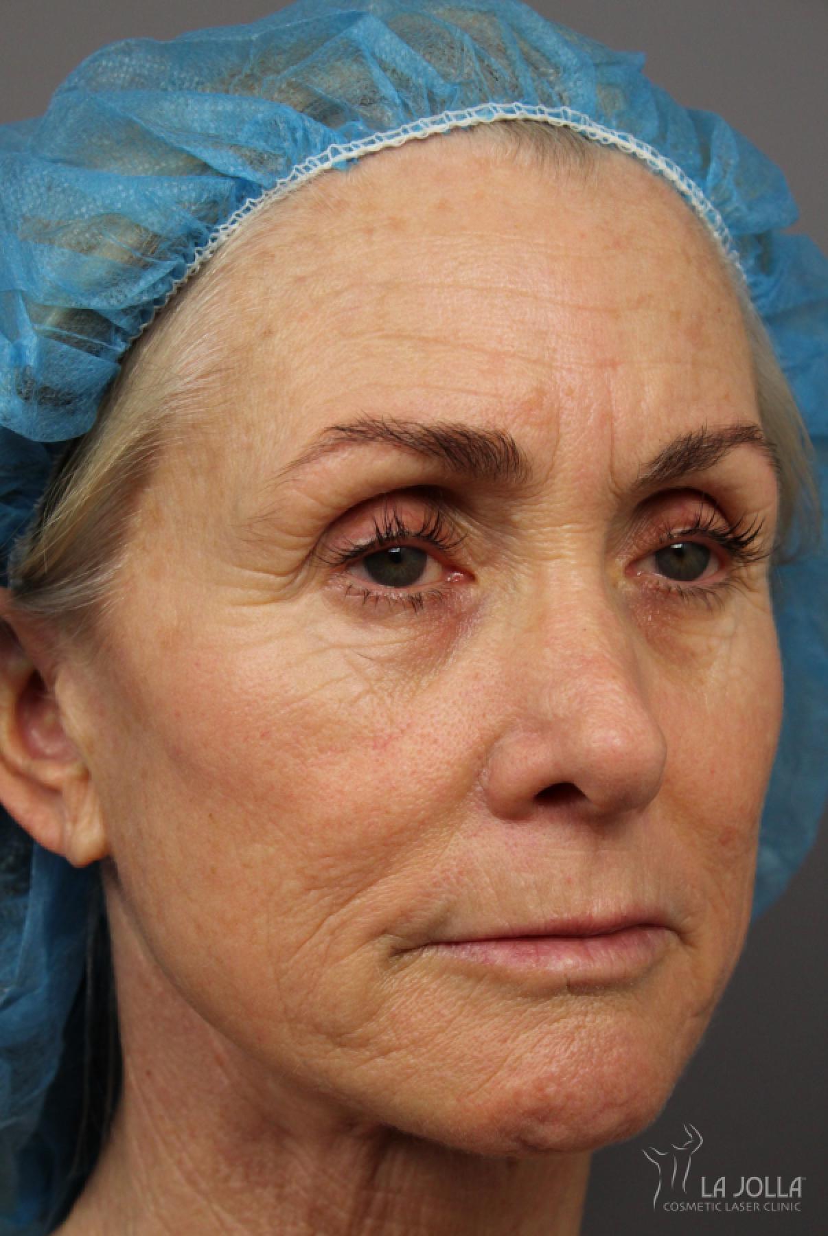 CO2 Laser: Patient 11 - Before 2