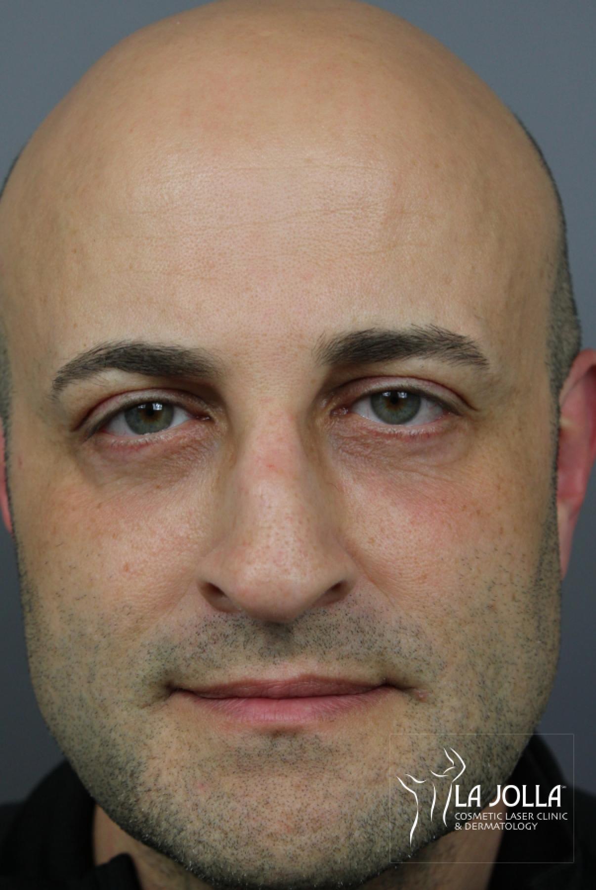 Sculptra Before After Gallery